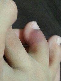 机の脚に足の指をぶつけました 昨日の夜ぶつけ １日たってなに Yahoo 知恵袋