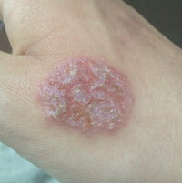 三ヶ月ほどまえから手のこうに湿疹ができてなかなか治りません皮膚科いったんです Yahoo 知恵袋