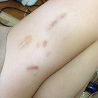 彼女が自傷行為をしました 刺したところは太ももです 彼女は夏に水着 Yahoo 知恵袋