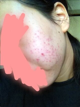 ゲンタシン にきび ダラシンtゲルは ニキビに効いているのか 専門家が本音で答えます