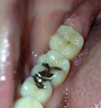 奥歯に黒点 虫歯 1番奥の歯に黒い点を発見しました 歯ブラシで何回も磨 Yahoo 知恵袋