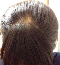 女のハゲです前髪がほとんどなくて地肌が丸見えよくいるバーコードおじさ Yahoo 知恵袋