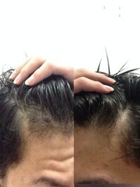 左右ってこんな生え際違うものですか 薄い方は むかしくせ毛だっ Yahoo Beauty