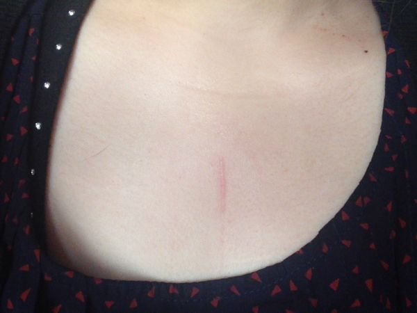 傷跡傷ひっかき傷治し方飼い猫に引っかかれてしまいました。胸元で 