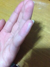 火傷の跡についてです 3日くらい前に鉄板に小指が当たってしまい やけどしてし Yahoo 知恵袋