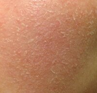 頬の画像 閲覧注意です 学生の女です 洗顔後 頬がこのよう Yahoo 知恵袋