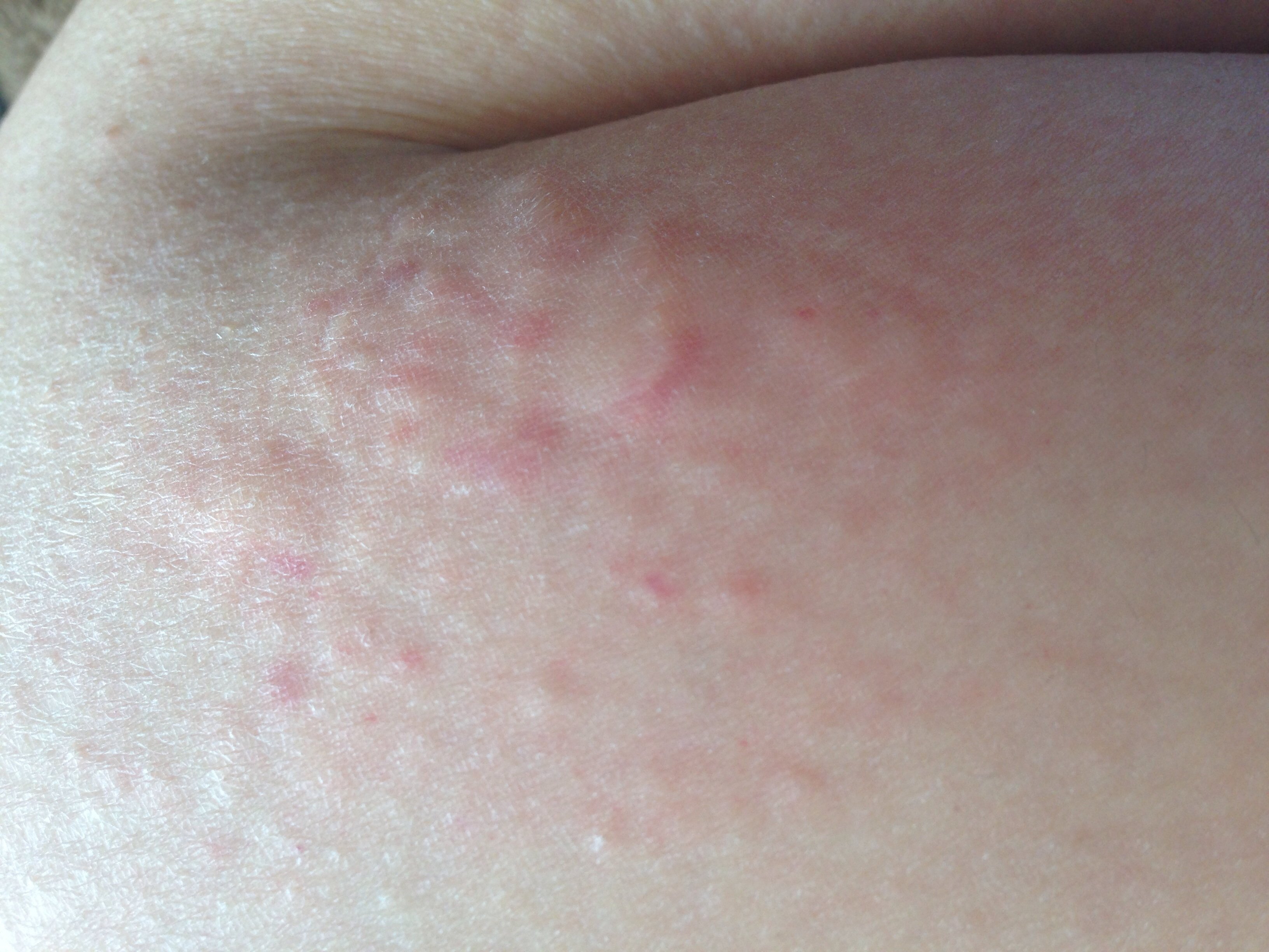 太ももが痒いです。※画像あり赤い湿疹みたいなものが出て、しばらくすると痒みが... - Yahoo!知恵袋