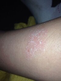 同じ位置にここ一年以上痒みがあり かくとポロポロと皮膚が剥が Yahoo 知恵袋