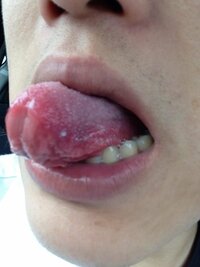 舌癌が心配です 舌の横に口内炎のような白いできものができたのですが いっこう Yahoo 知恵袋