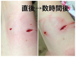 猫に噛まれました 傷の写真あり 家で飼っている猫です 今まで引 Yahoo 知恵袋