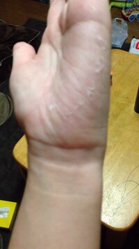 最近写真のように手の皮 がむけるんですけど 正直恥ずかしいです 治 Yahoo 知恵袋
