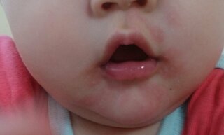 食物アレルギー 9ヶ月の娘の発疹について質問させてください 本日 Yahoo 知恵袋