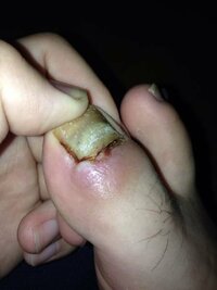 爪を剥がした後の処置は 先日 足の親指の爪を引っ掛けて 爪を剥がす Yahoo 知恵袋