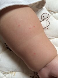 生後6ヶ月男の子ですが 腕に赤い湿疹が1箇所出来てしまいました Yahoo 知恵袋