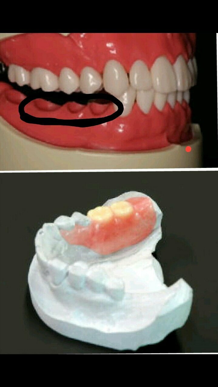 奥歯 2 入れ歯 本 部分 上あごの奥歯２本ない方への入れ歯