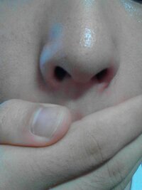 鼻 の 周り 赤み 恥ずかしい 鼻の赤み の原因と 正しいスキンケア１０選 Govotebot Rga Com