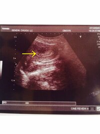 妊娠初期です 先生が 多分これ胎嚢 と言いますが 胎嚢に見えますか 小さいの Yahoo 知恵袋