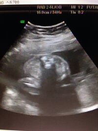 27週の胎児のエコーです この真ん中にある丸い物体はおちんちんです Yahoo 知恵袋