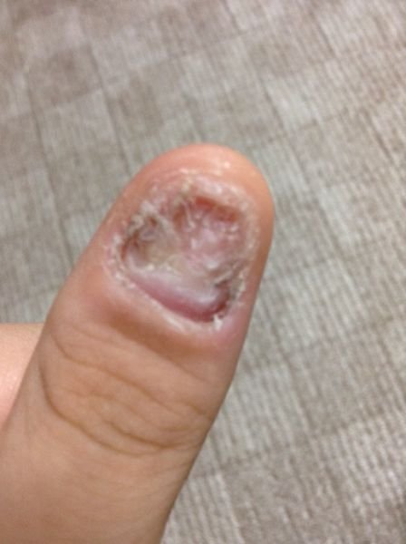 爪が剥がれたあとそのままにしていたら、下のようになってしまいました 