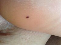 足の裏 かかとにほくろ 中学生です 昨日のことなんとなくかかとを見たらほくろ Yahoo 知恵袋