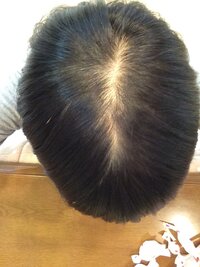 中学生女子 薄毛について中学３年生女子です薄毛に悩んでいます 5月くらいから Yahoo 知恵袋