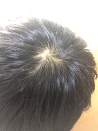 高校生男子です これはagaの始まりなのでしょうか 抜け毛の季節で Yahoo 知恵袋