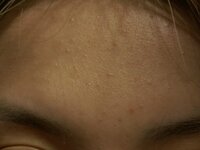 質問です 19歳 女です 肌荒れにずっと悩んでいます おでこの細かいぶつぶつ Yahoo 知恵袋