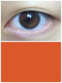 目の色が一部違うんですけど 虹彩異色症ですか 虹彩異色症には光彩の一部 Yahoo 知恵袋