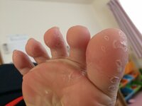 足の裏の指の皮がすごく剥けます 洗ってても剥けます どうしたらいいですか Yahoo 知恵袋
