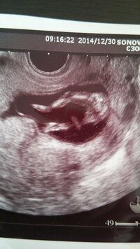 妊娠12週のエコーです 産まれてくるのが待ち遠しいです 性別は希 Yahoo 知恵袋