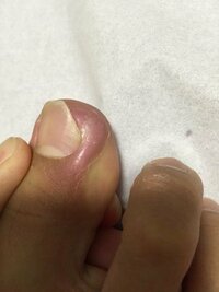 1ヶ月程前から足の親指の爪と皮膚のところが腫れはじめました 色々調べて Yahoo 知恵袋