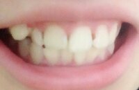 高校生女です 前歯に何個か虫歯ができてしまいました 写真見にくいと Yahoo 知恵袋