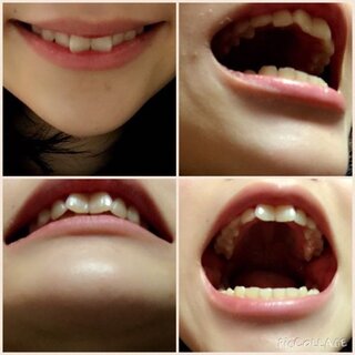 歯並び部分矯正 歯の画像あります私の前歯はねじれています 優香 Yahoo 知恵袋