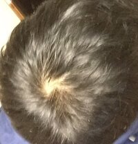 若ハゲ Agaに関して 助けて下さい ステマやコピペの文章は勘 Yahoo 知恵袋