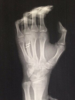 左手の薬指の中手骨を斜骨折したため 先日手術でスクリュー ボルト 2本を折れ Yahoo 知恵袋