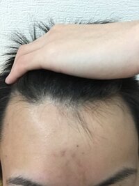 生え際気になります もともとおでこ広いですが左右が真ん中より広いです 右が6 Yahoo 知恵袋