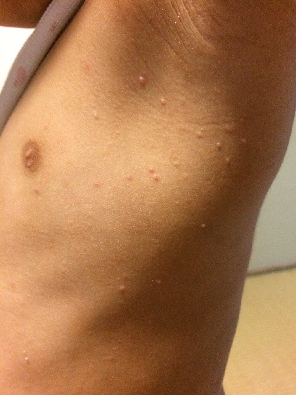 4歳の娘のわき腹に湿疹ができてます これは水いぼでしょうか 教えて Yahoo 知恵袋