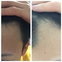 生え際左右気になります 生え際が眉毛から右が6 5左が6です 真ん Yahoo 知恵袋