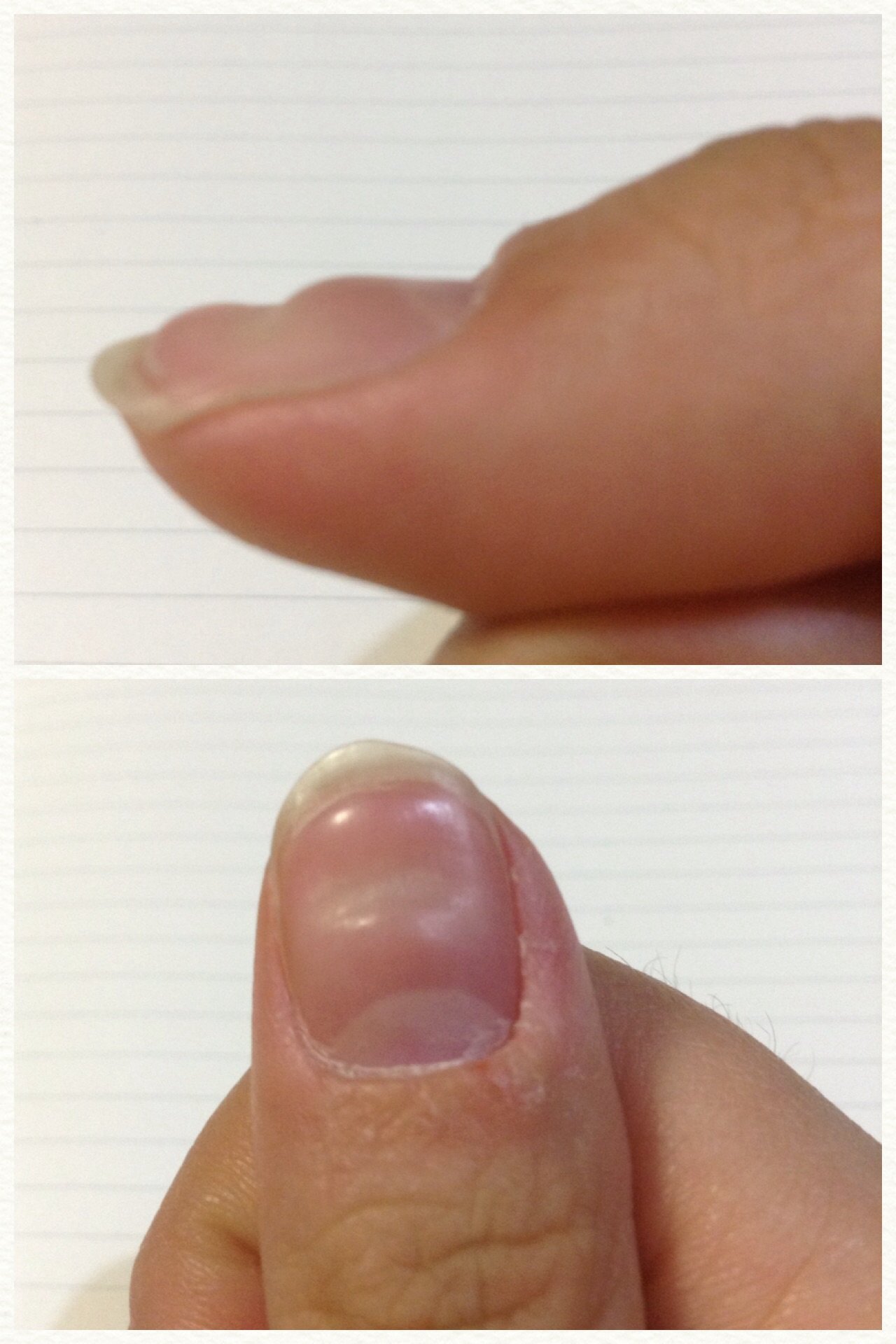 最も検索 親指 爪 でこぼこ