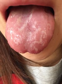 舌に2 3日前から白い模様ができ 毎日形がかわります 痛いという感 Yahoo 知恵袋