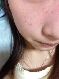 高校生の女子です 悩みなんですけど 私はそばかすがひどくてほんとに困 Yahoo 知恵袋