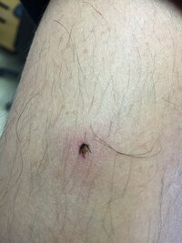 山にて、不思議な虫が身体に刺さっているのを今朝発見しました。
まだ足が動いています。
丸一日たって発見しました。

この虫はなんという虫でしょうか？ 