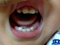 1歳の赤ちゃんの前歯に茶色の筋が一本あります ネットで調べたら 茶渋だと書 Yahoo 知恵袋
