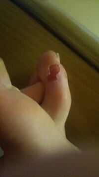 靴擦れで指の皮が剥けてしまいました 痛いです どうすればいいでしょ Yahoo 知恵袋