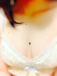 小さい頃から胸の谷間にほくろがあります わりと大きいし昔からコンプ Yahoo 知恵袋