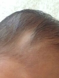 ３ヶ月の赤ちゃんに円形脱毛があります 最近までちゃんと生えてたと思います Yahoo 知恵袋