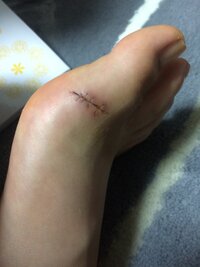 抜糸後について 画像ありグロ注意 閲覧頂きありがとうございます 家 Yahoo 知恵袋