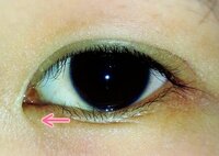 この目頭から出てるしわ みたいな線って消せないんでしょうか Yahoo 知恵袋