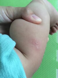 指しゃぶりのし過ぎで水ぶくれが うちの４ヶ月の息子は 指しゃぶ Yahoo 知恵袋