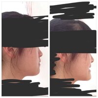 画像あり しゃくれのせいで男子にからかわれて辛いです 親の遺伝で Yahoo 知恵袋